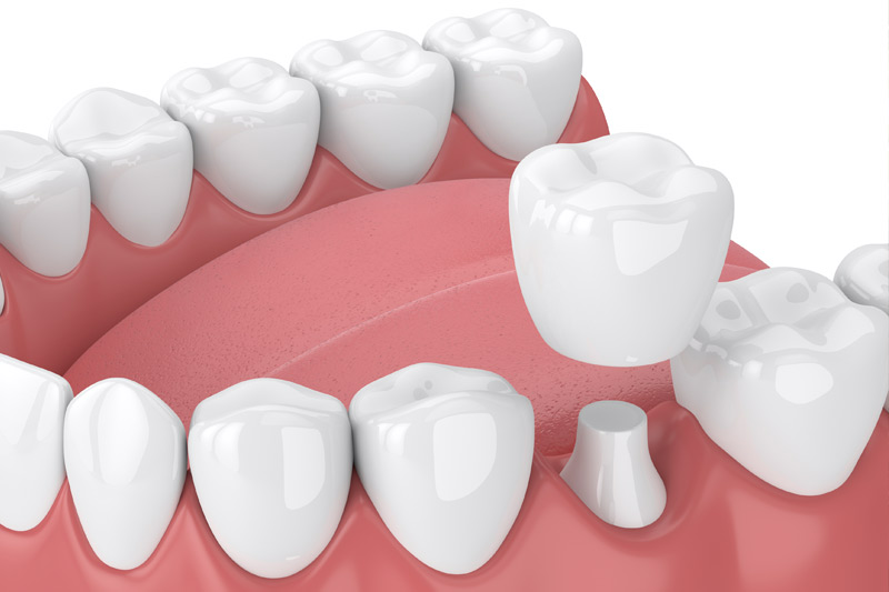 Dental Crowns in Cleburne